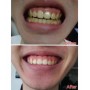 7 Days Whitening Teeth Kit 美白牙仪